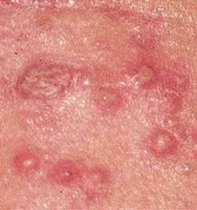 Acne e Espinhas podem deixar marcas e lesões na pele