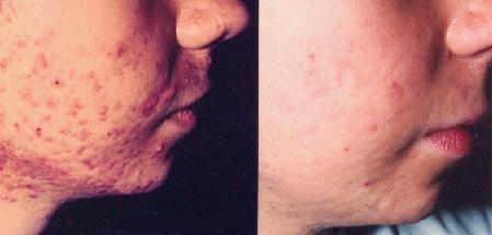 Acne antes e depois do tratamento com isotretinoína.