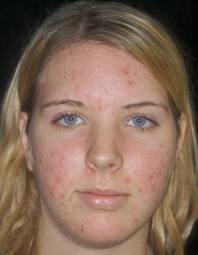 Foto de uma adolescente com acne, cravos e espinhas.